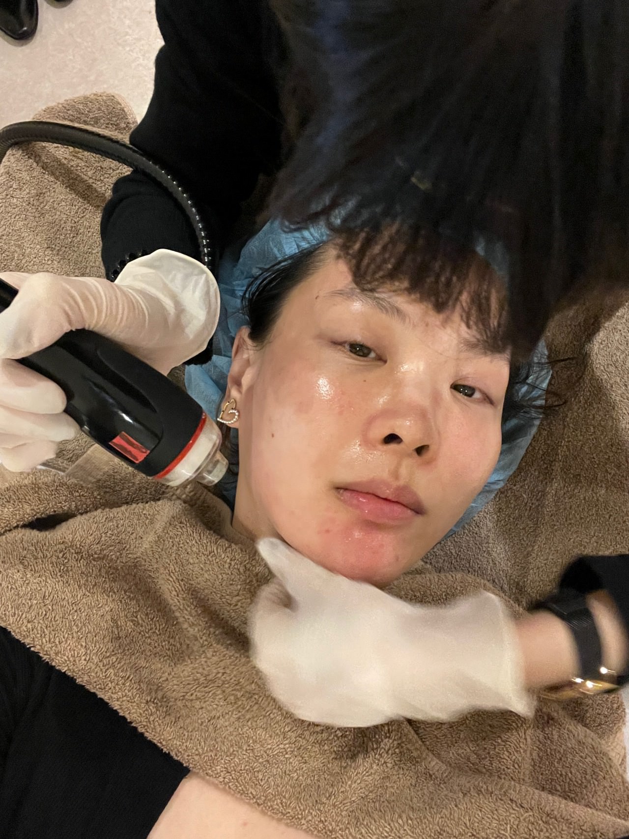 【油痘粉刺肌必看】佳思優整形醫美診所『黑鑽水飛梭』初體驗，粉刺大掃除，肌膚亮出新高度～