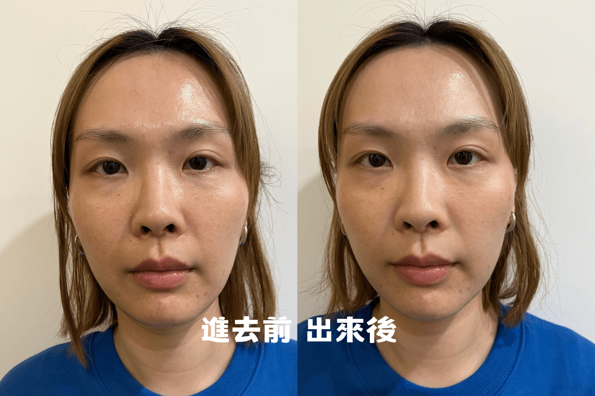 BBL青春光耀效果如何？賦真妍 2023 最新一代寬頻光保養課程，不痛且無修復期，定期保養讓素顏美到發光。