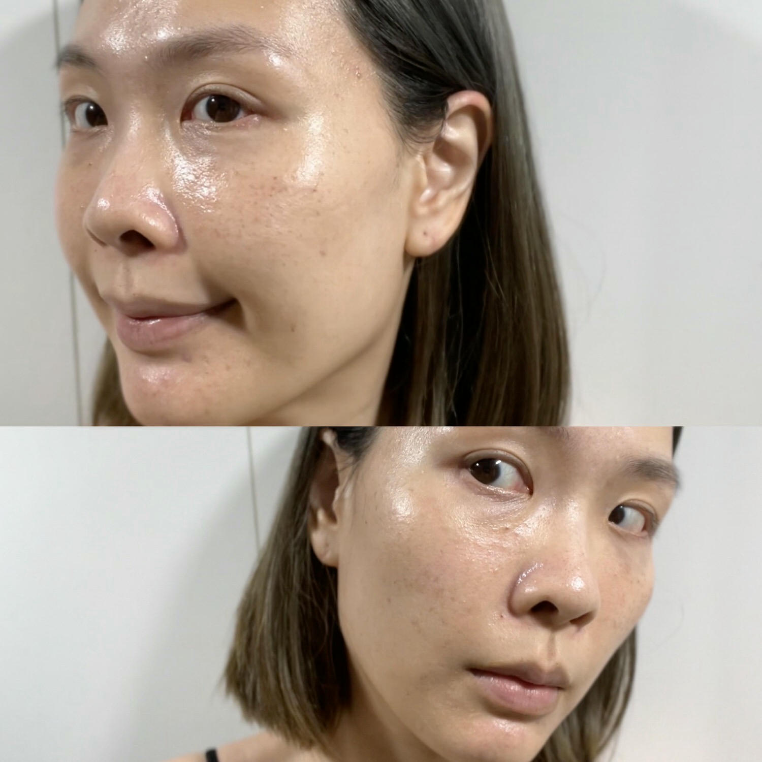 2023Dcard推薦彩衝光M22是什麼？花花臉、紅痘印、色素沈澱大掃除！台北悠美診所彩衝光M22體驗心得