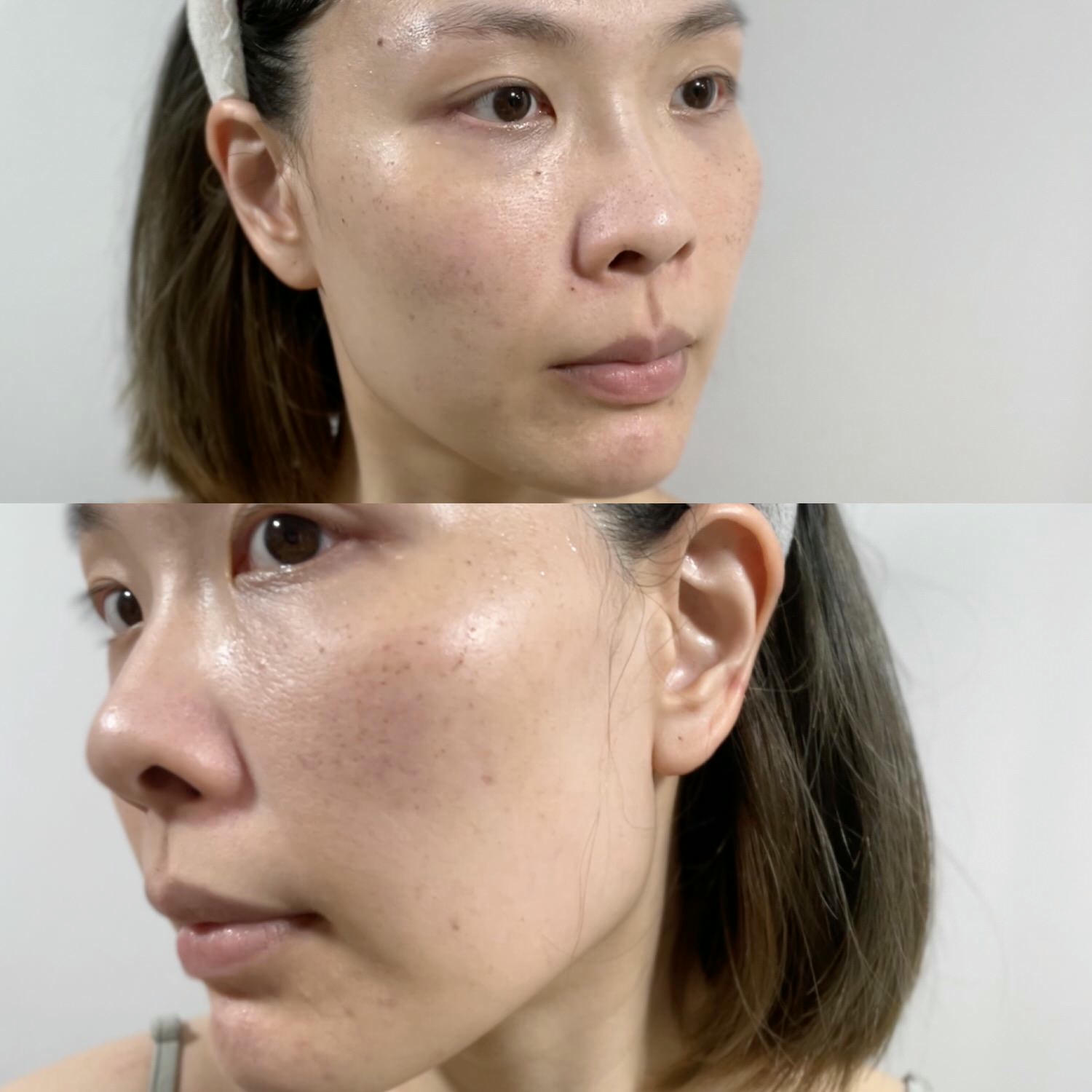 2023Dcard推薦彩衝光M22是什麼？花花臉、紅痘印、色素沈澱大掃除！台北悠美診所彩衝光M22體驗心得