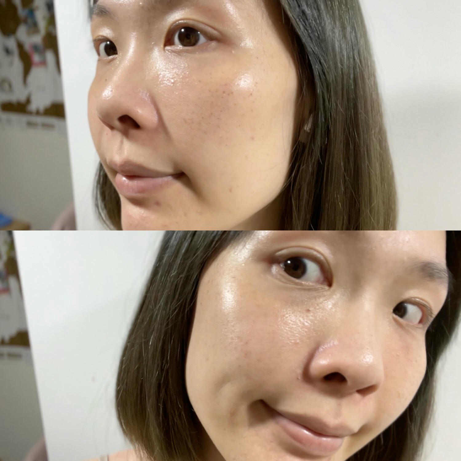 2023Dcard推薦彩衝光M22是什麼？花花臉、紅痘印、色素沈澱大掃除！台北悠美診所彩衝光M22體驗心得