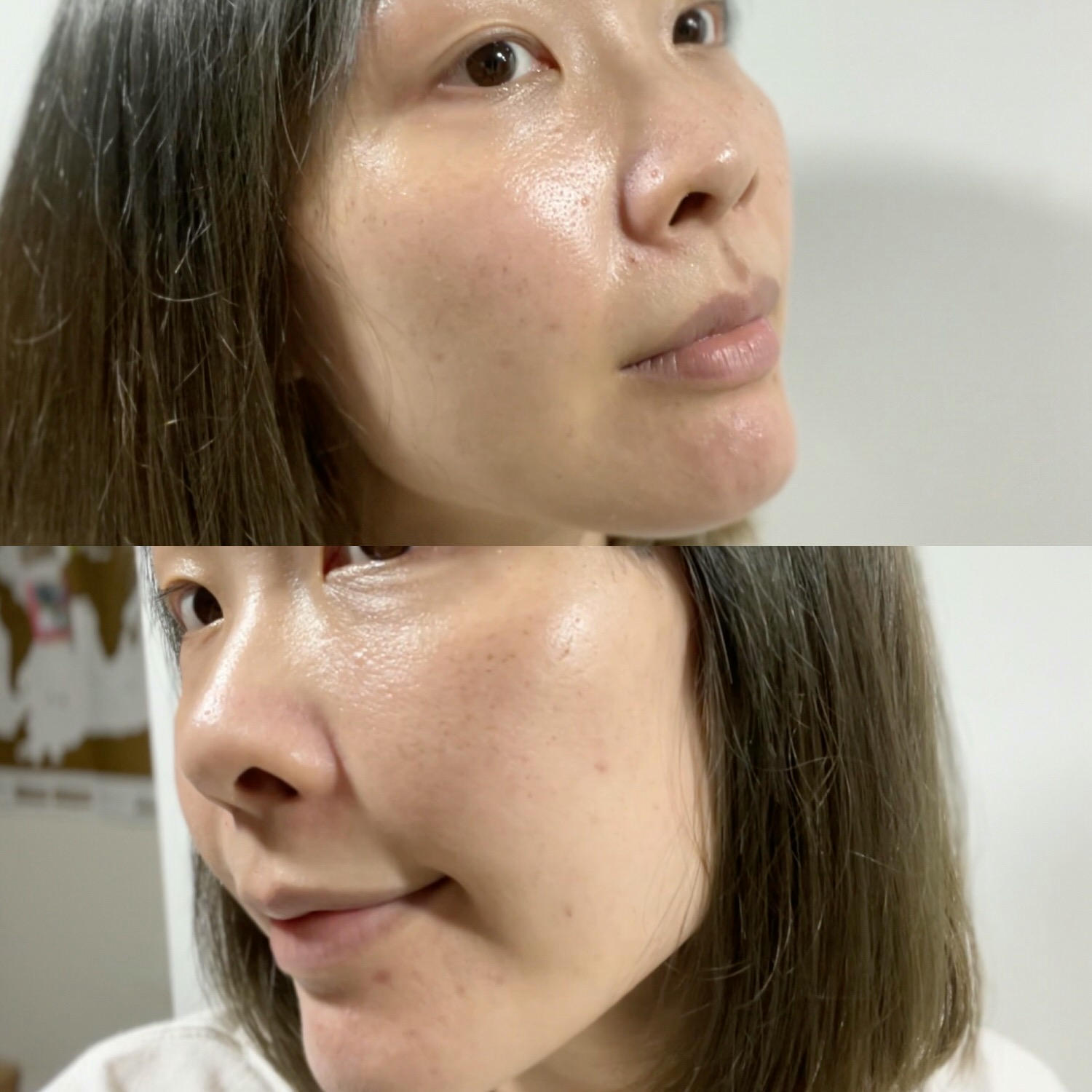 2023Dcard推薦彩衝光M22是什麼？花花臉、紅痘印、色素沈澱大掃除！台北悠美診所彩衝光M22體驗心得