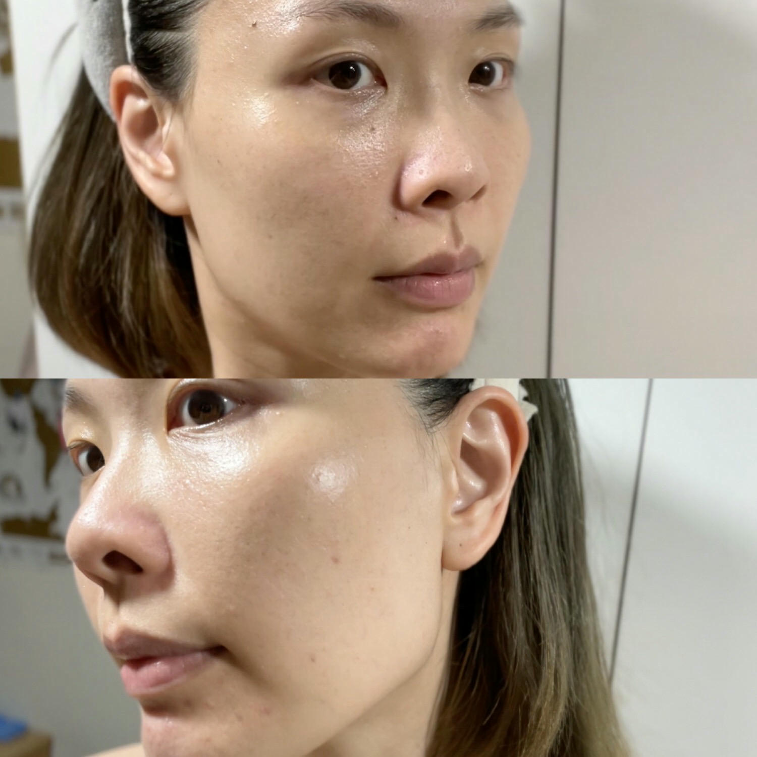 2023Dcard推薦彩衝光M22是什麼？花花臉、紅痘印、色素沈澱大掃除！台北悠美診所彩衝光M22體驗心得