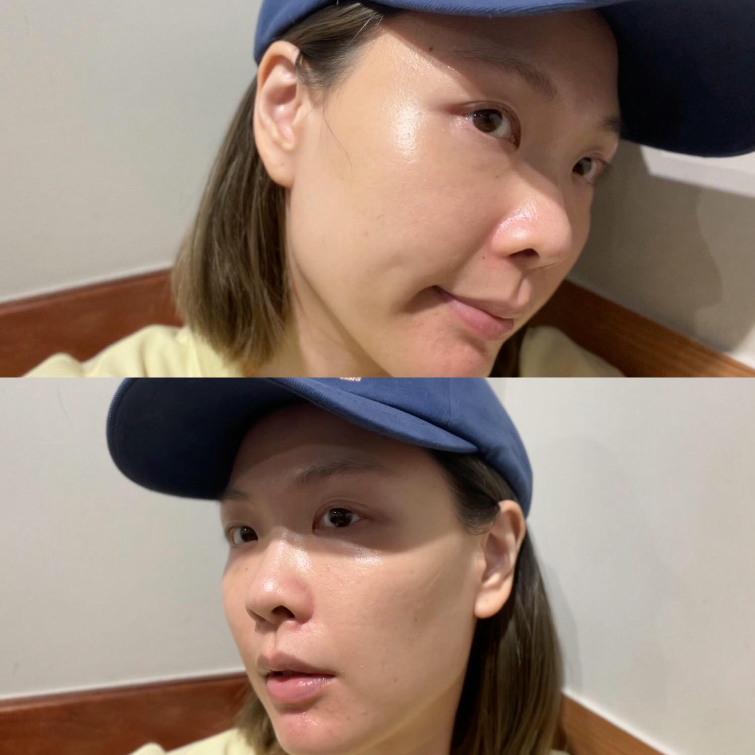 2023Dcard推薦彩衝光M22是什麼？花花臉、紅痘印、色素沈澱大掃除！台北悠美診所彩衝光M22體驗心得