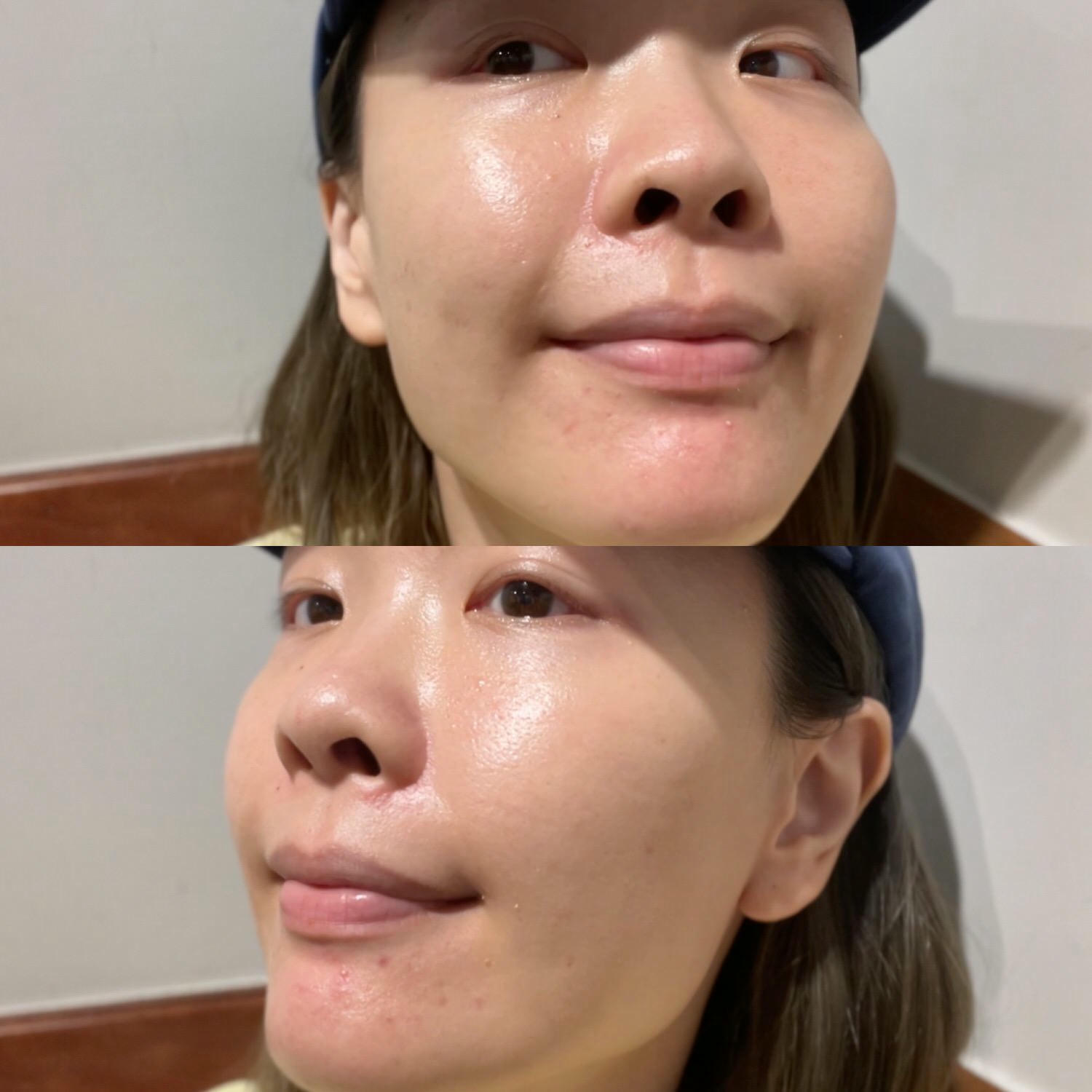 2023Dcard推薦彩衝光M22是什麼？花花臉、紅痘印、色素沈澱大掃除！台北悠美診所彩衝光M22體驗心得