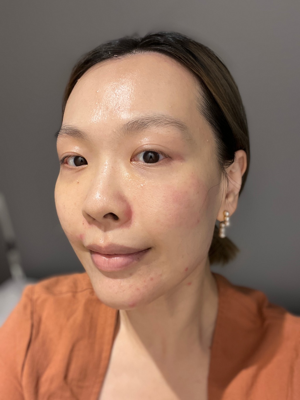 2023Dcard推薦彩衝光M22是什麼？花花臉、紅痘印、色素沈澱大掃除！台北悠美診所彩衝光M22體驗心得