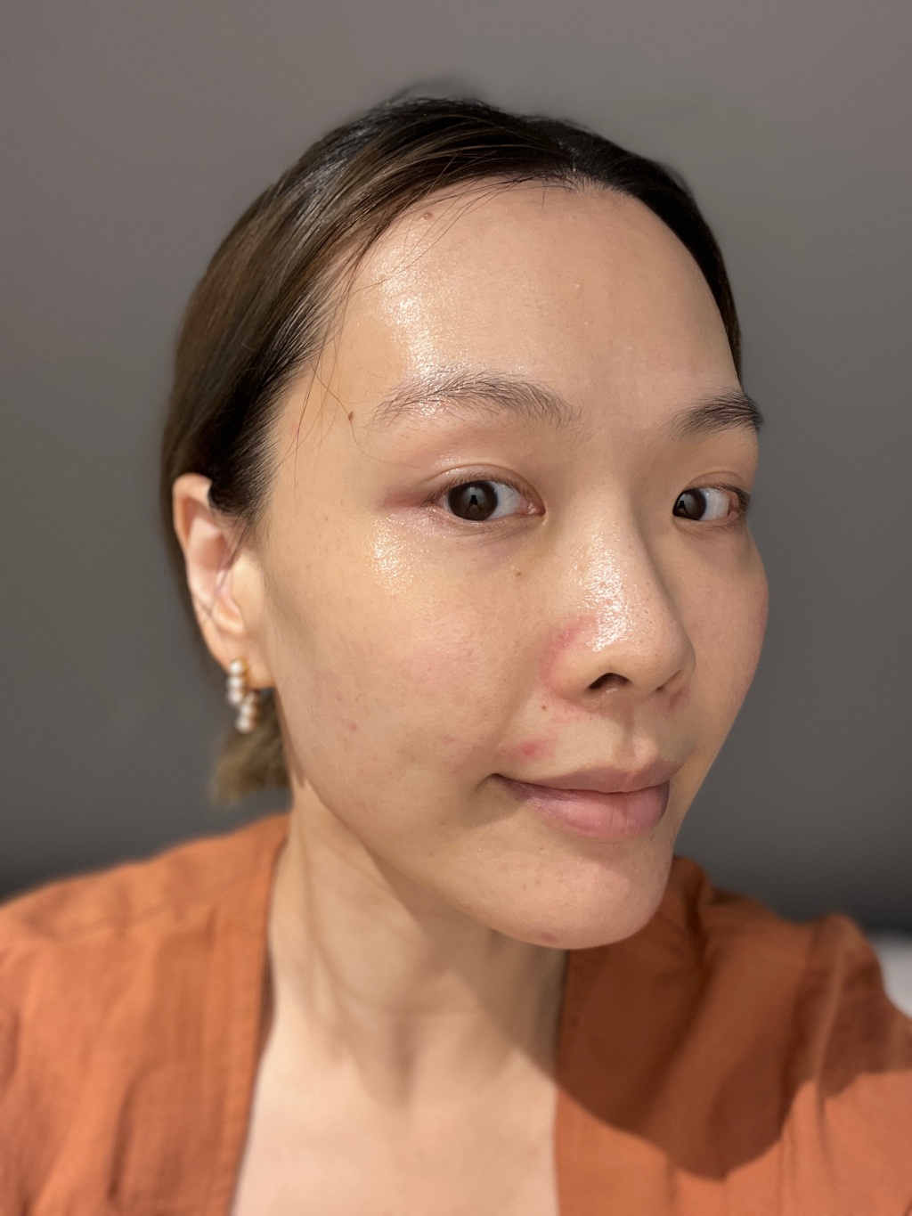 2023Dcard推薦彩衝光M22是什麼？花花臉、紅痘印、色素沈澱大掃除！台北悠美診所彩衝光M22體驗心得