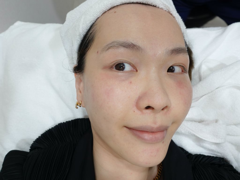 2023Dcard推薦彩衝光M22是什麼？花花臉、紅痘印、色素沈澱大掃除！台北悠美診所彩衝光M22體驗心得