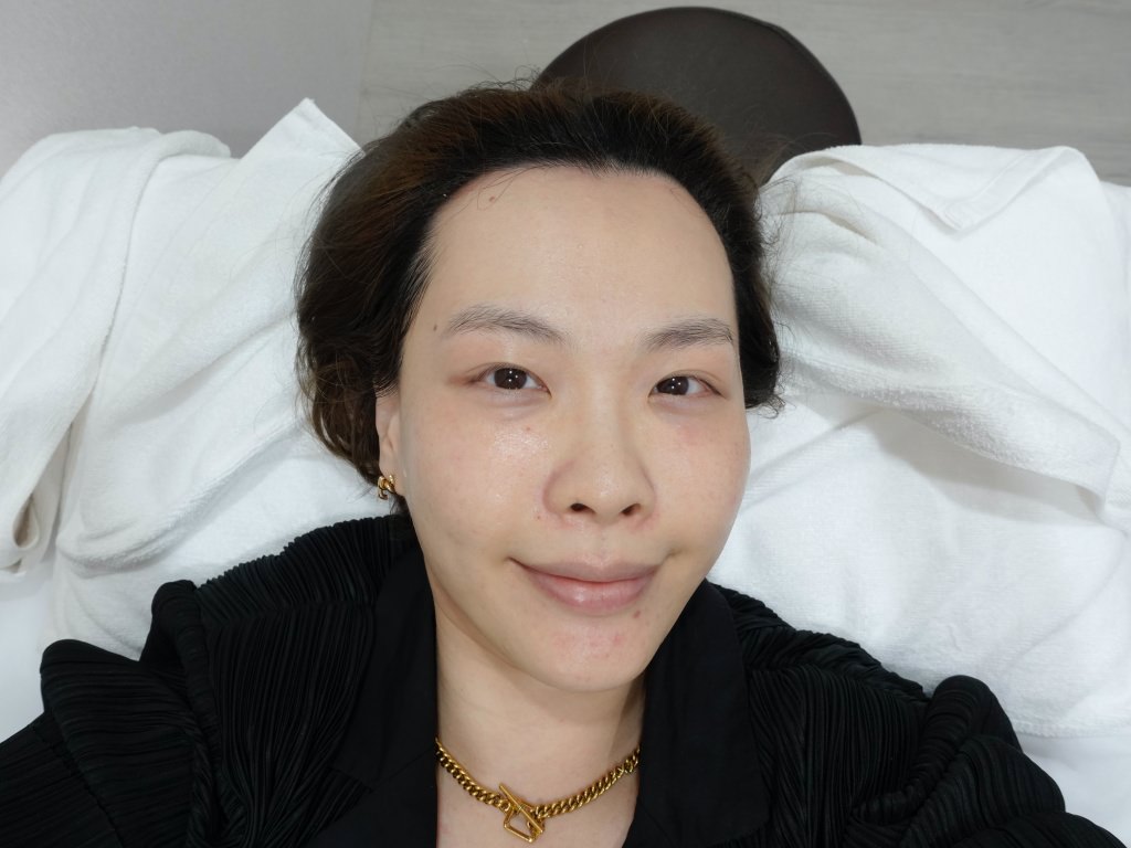 2023Dcard推薦彩衝光M22是什麼？花花臉、紅痘印、色素沈澱大掃除！台北悠美診所彩衝光M22體驗心得