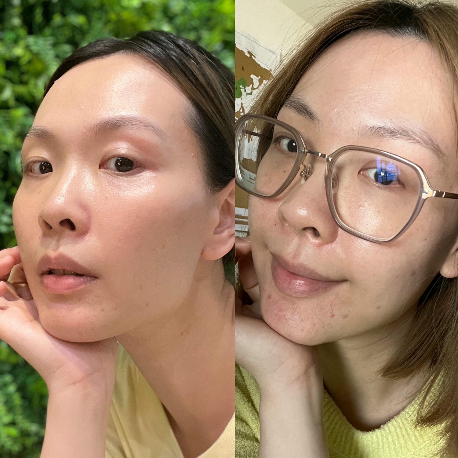2023Dcard推薦彩衝光M22是什麼？花花臉、紅痘印、色素沈澱大掃除！台北悠美診所彩衝光M22體驗心得