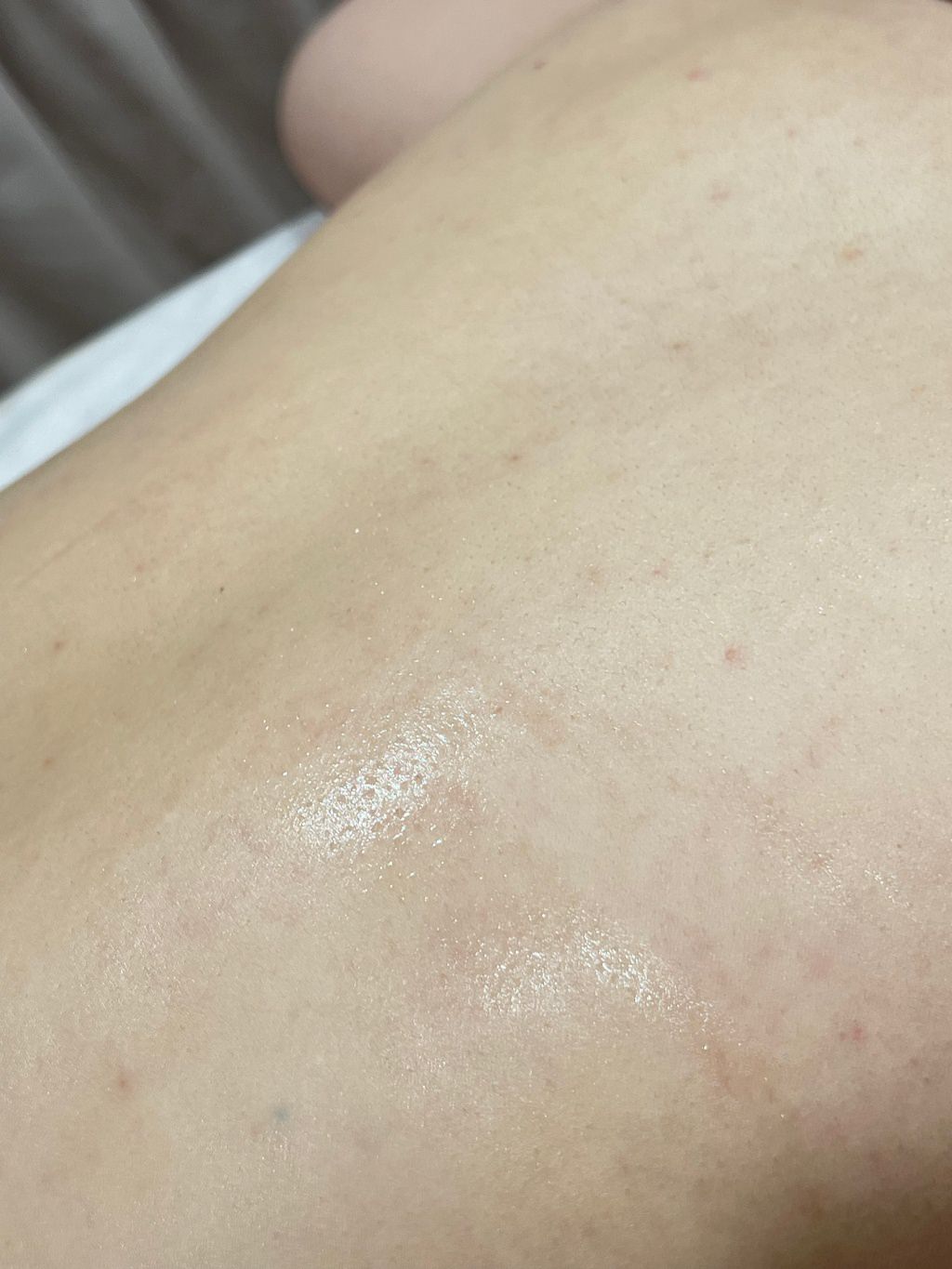 【杏仁酸美背推薦】背痘粉刺、暗沈毛孔滾開，手指滑倒般的觸感❤️台北花漾國際美學診所，超認真杏仁酸美背初體驗！