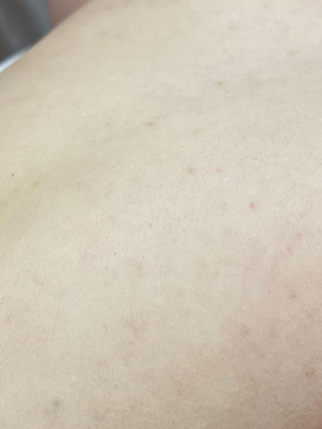【杏仁酸美背推薦】背痘粉刺、暗沈毛孔滾開，手指滑倒般的觸感❤️台北花漾國際美學診所，超認真杏仁酸美背初體驗！