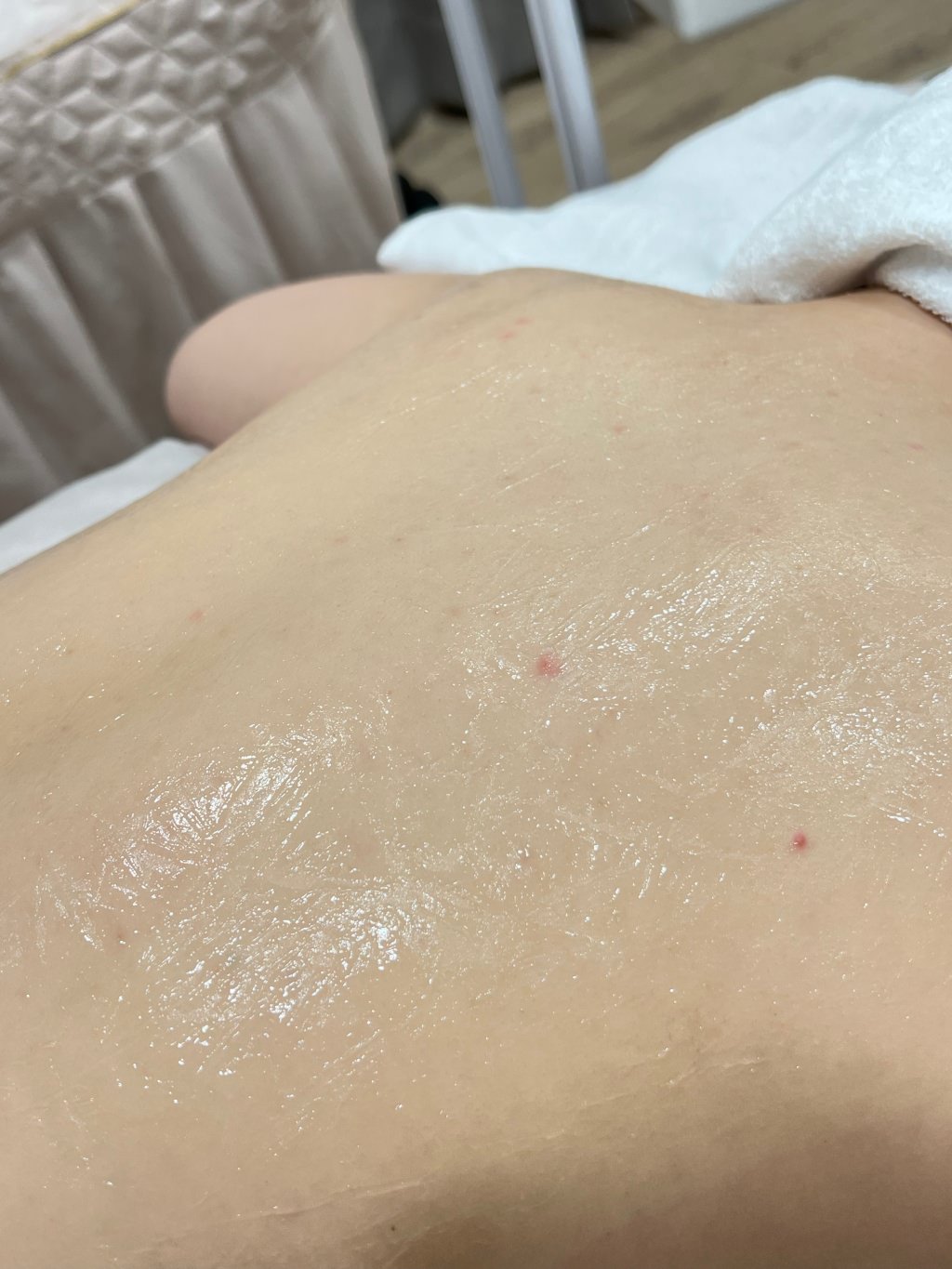 【杏仁酸美背推薦】背痘粉刺、暗沈毛孔滾開，手指滑倒般的觸感❤️台北花漾國際美學診所，超認真杏仁酸美背初體驗！