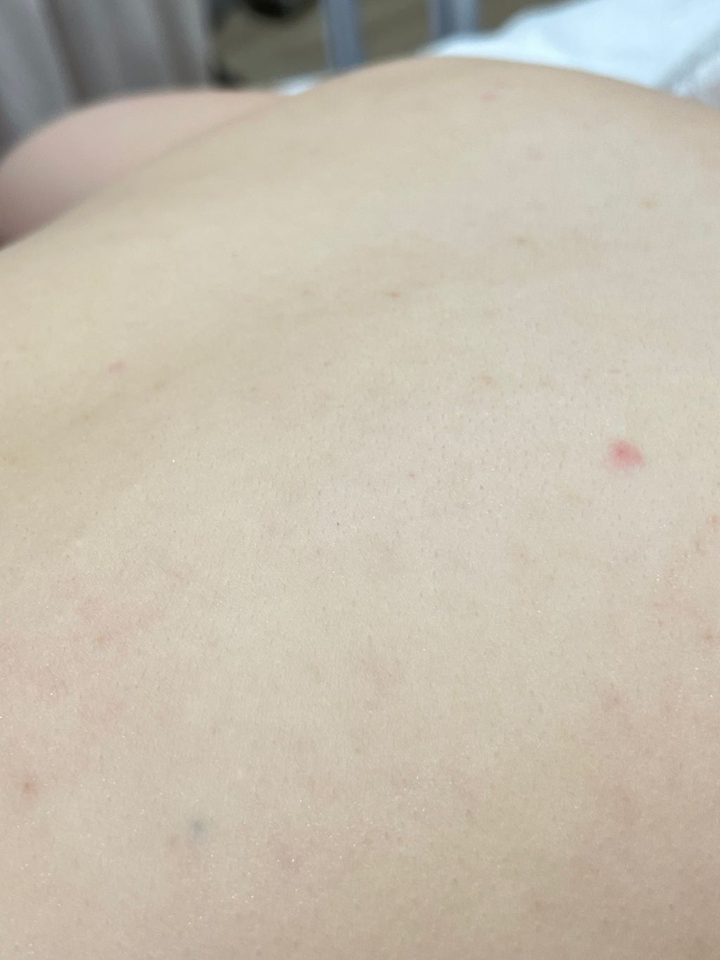 【杏仁酸美背推薦】背痘粉刺、暗沈毛孔滾開，手指滑倒般的觸感❤️台北花漾國際美學診所，超認真杏仁酸美背初體驗！
