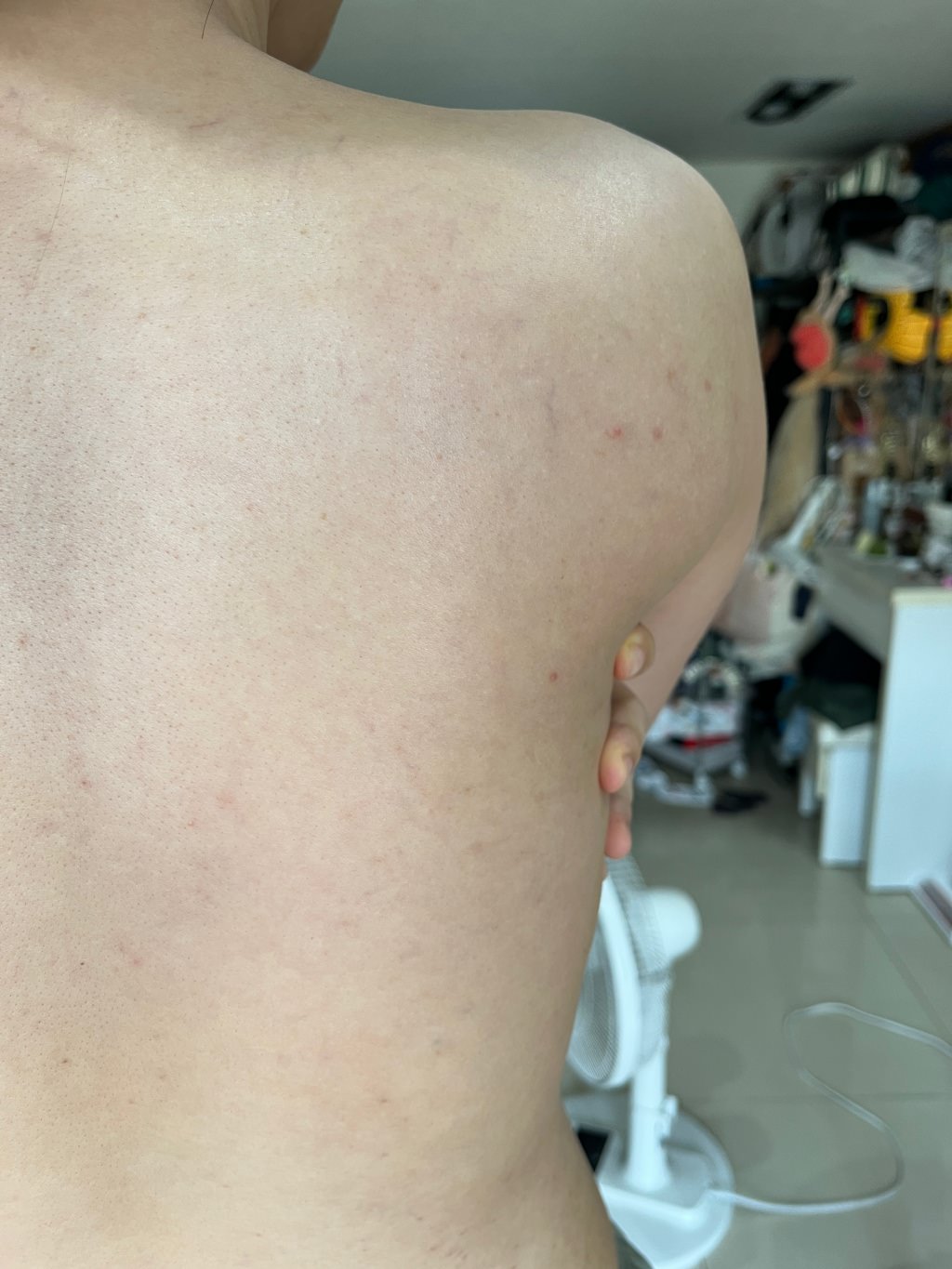 【杏仁酸美背推薦】背痘粉刺、暗沈毛孔滾開，手指滑倒般的觸感❤️台北花漾國際美學診所，超認真杏仁酸美背初體驗！