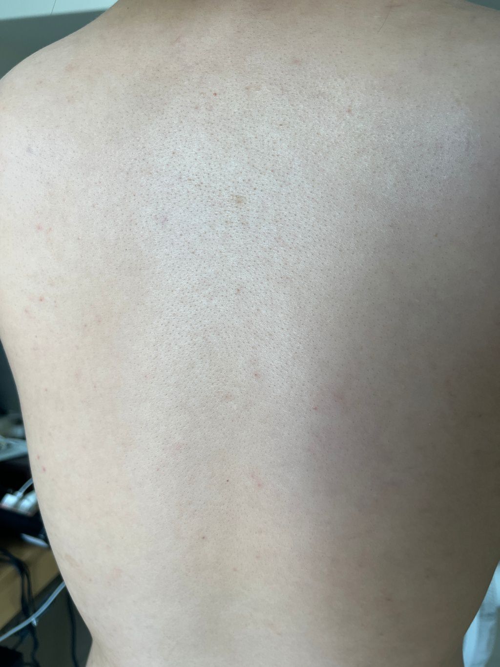 【杏仁酸美背推薦】背痘粉刺、暗沈毛孔滾開，手指滑倒般的觸感❤️台北花漾國際美學診所，超認真杏仁酸美背初體驗！