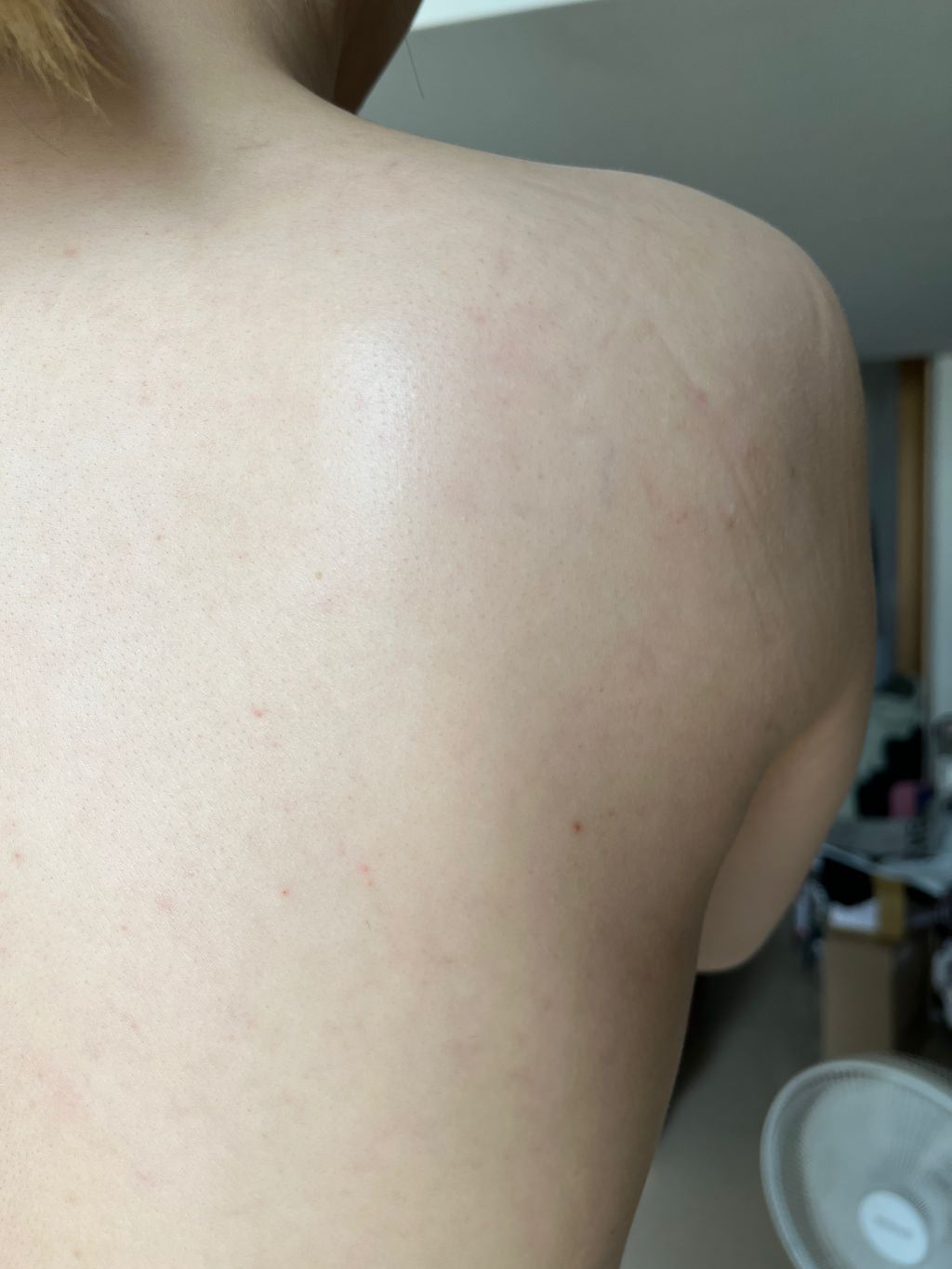【杏仁酸美背推薦】背痘粉刺、暗沈毛孔滾開，手指滑倒般的觸感❤️台北花漾國際美學診所，超認真杏仁酸美背初體驗！