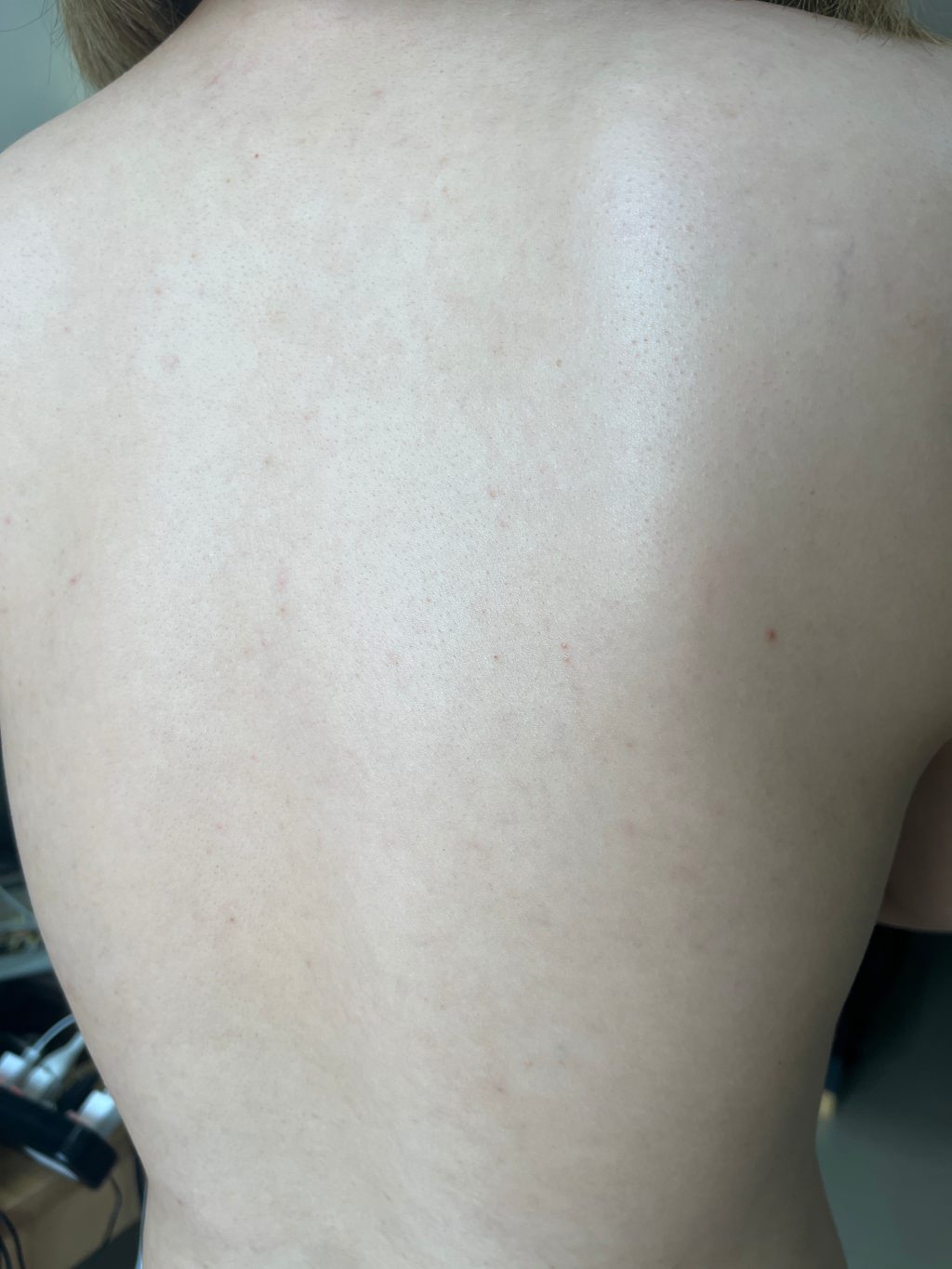【杏仁酸美背推薦】背痘粉刺、暗沈毛孔滾開，手指滑倒般的觸感❤️台北花漾國際美學診所，超認真杏仁酸美背初體驗！