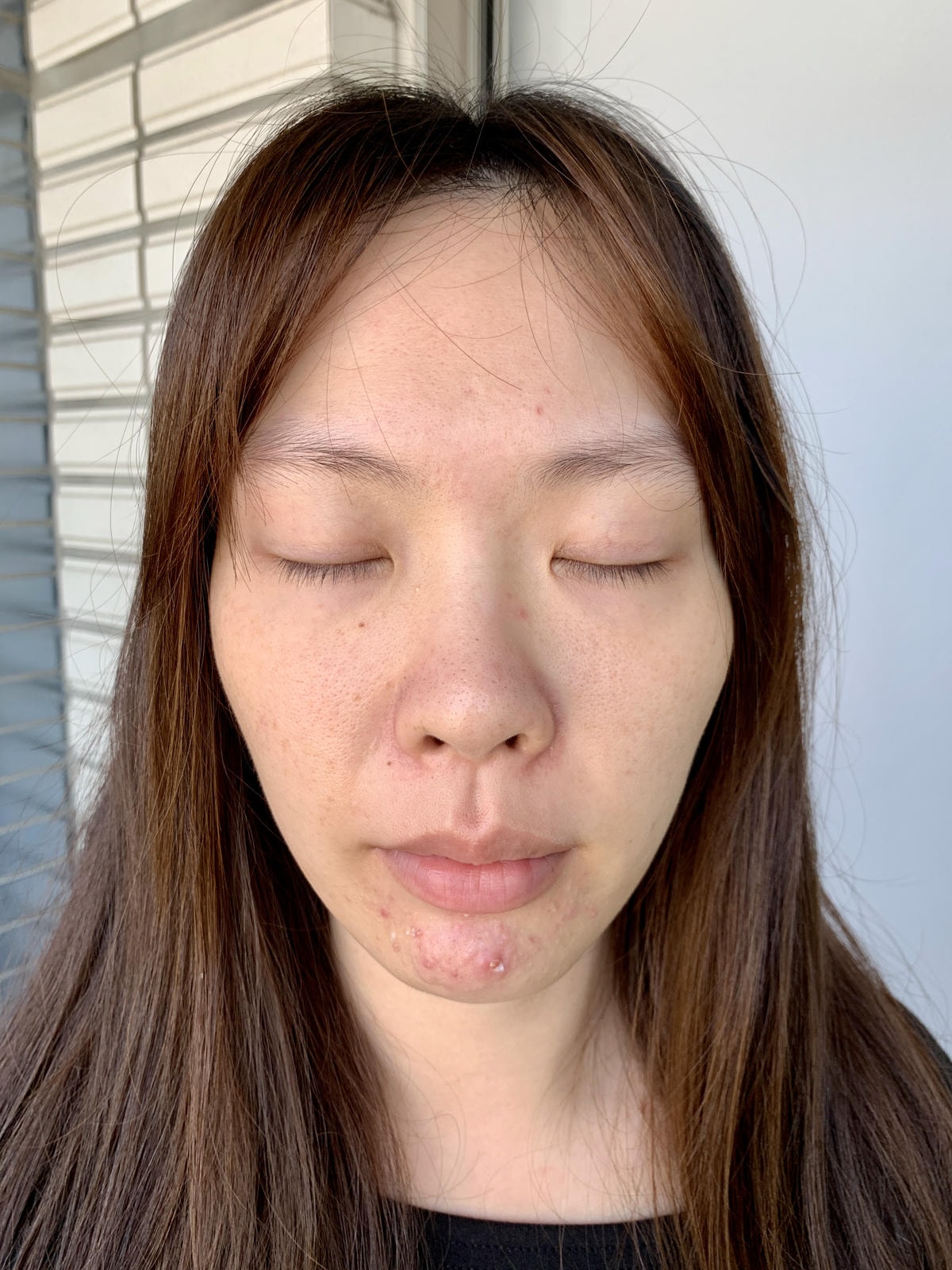 沒打水光針，卻亮回素顏巔峰！我怎麼靠「胎盤素噴霧」從酒糟肌養出發光肌？（文末優惠）