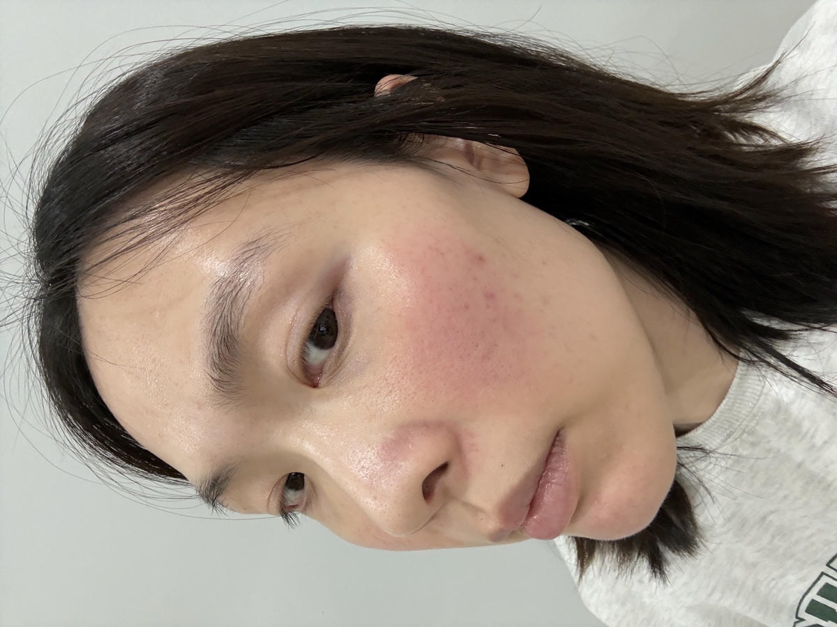 沒打水光針，卻亮回素顏巔峰！我怎麼靠「胎盤素噴霧」從酒糟肌養出發光肌？（文末優惠）