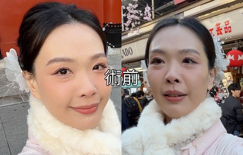 【醫美真心話】告別「見光死」大眼袋！38歲內開不補脂全紀錄：7 間診所諮詢心得＋超詳盡術前後保養清單