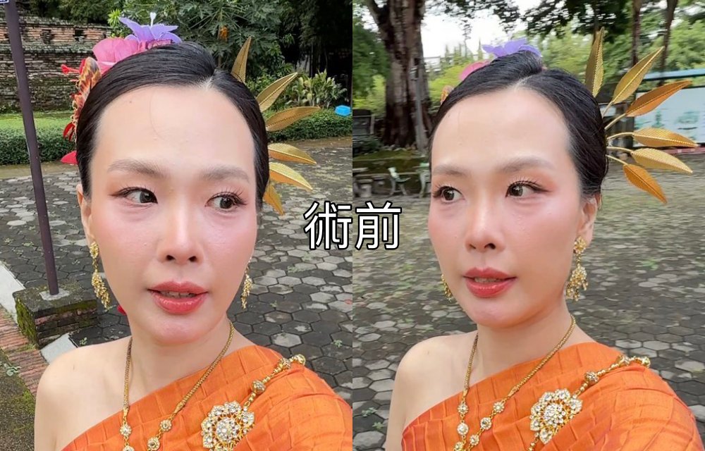 【醫美真心話】告別「見光死」大眼袋！38歲內開不補脂全紀錄：7 間診所諮詢心得＋超詳盡術前後保養清單