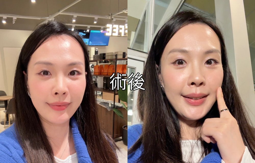 【醫美真心話】告別「見光死」大眼袋！38歲內開不補脂全紀錄：7 間診所諮詢心得＋超詳盡術前後保養清單