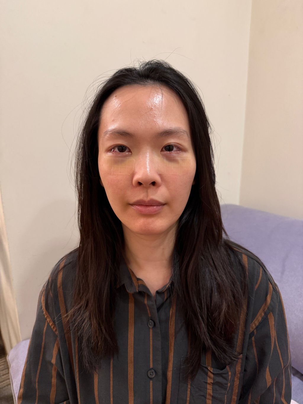 【醫美真心話】告別「見光死」大眼袋！38歲內開不補脂全紀錄：7 間診所諮詢心得＋超詳盡術前後保養清單