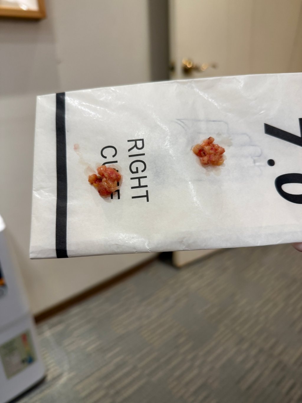 【醫美真心話】告別「見光死」大眼袋！38歲內開不補脂全紀錄：7 間診所諮詢心得＋超詳盡術前後保養清單