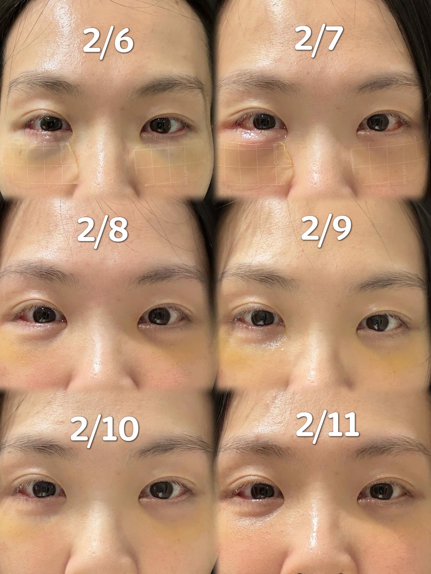 【醫美真心話】告別「見光死」大眼袋！38歲內開不補脂全紀錄：7 間診所諮詢心得＋超詳盡術前後保養清單